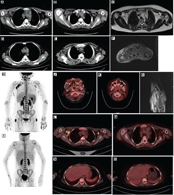 Acute necrotizing encephalopathy associated with lymphoma-associated hemophagocytic lymphohistiocytosis: A case report and literature review